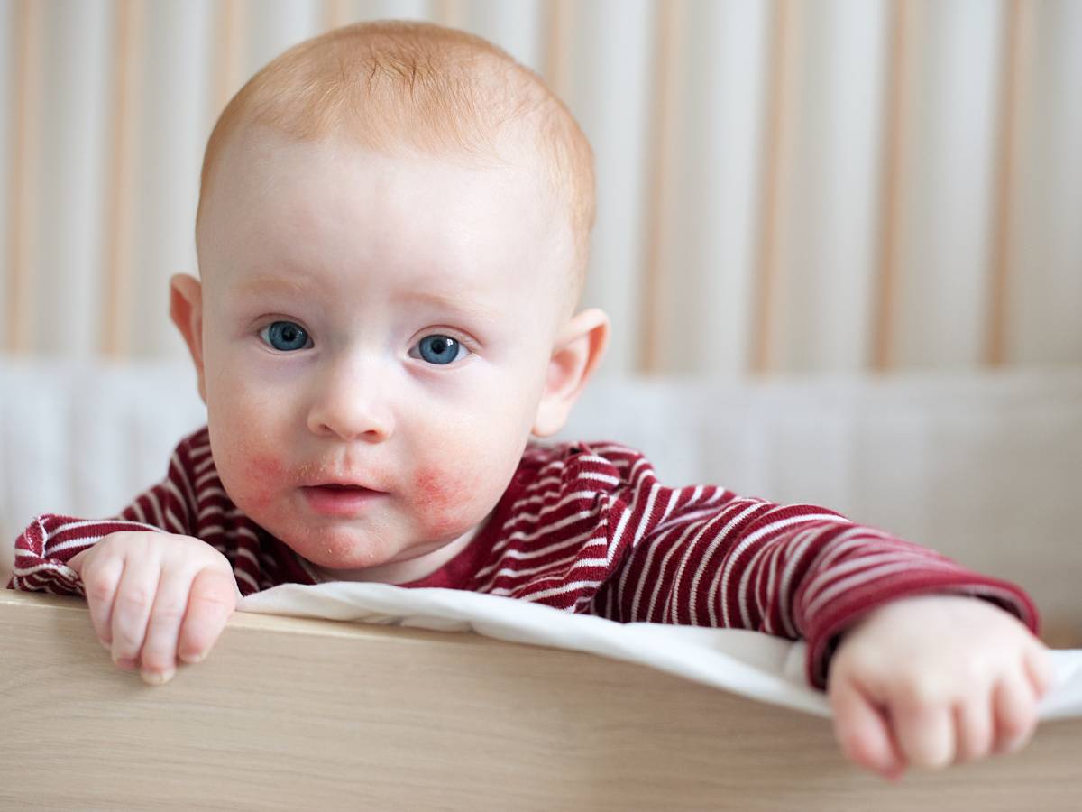 Niemowlę z AZS. Obrazek w artykule Atopowe zapalenie skóry. Domowe sposoby na łagodzenie AZS