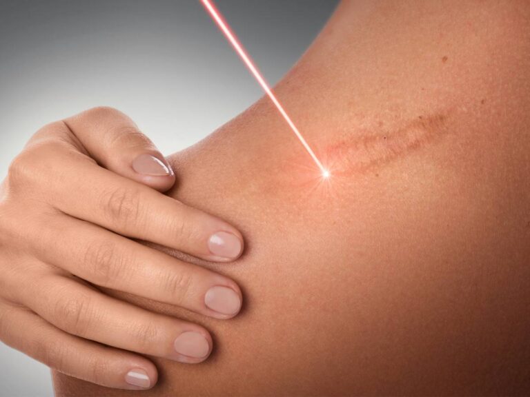 Lase na blizny. Domowe sposoby na blizny - jak pozbyć się ich skutecznie?