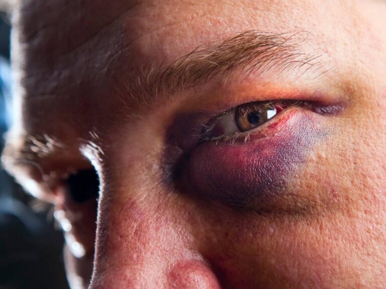Oczy po ciosie bokserski. Obrazek w artykule Bokserskie sposoby na podbite oko. Jak zapobiegać podbitym oczom i innym kontuzjom na treningu?