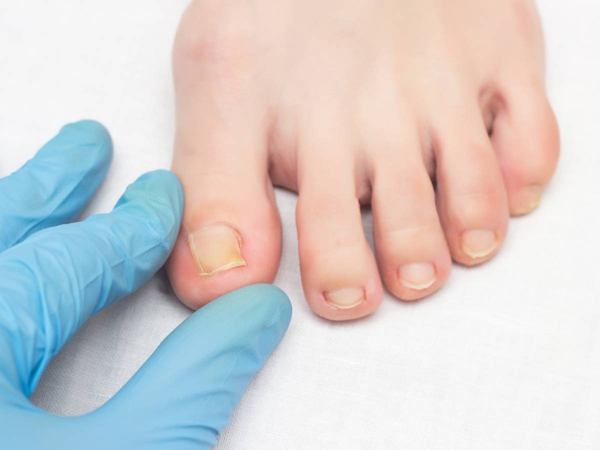 Chore paznokcie. Obrazek w artykule Domowy sposób na grzybicę paznokci. Sprawdzone metody leczenia grzybicy.