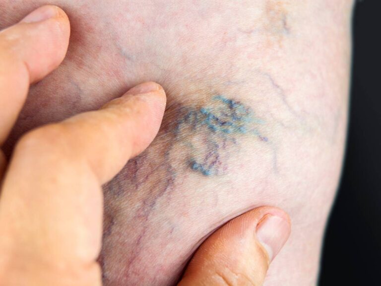 Żyły i cholesterol. Obrazek w artykule Stary niemiecki sposób na oczyszczenie żył - skuteczne metody i zasady