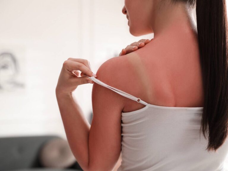 Zaczerwieniona skóra po opalaniu. Obrazek w artykule Sposób na oparzenia słoneczne. Skuteczne sposoby na oparzenie słoneczne.