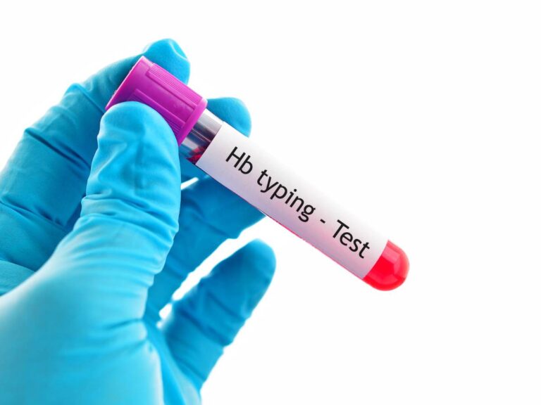 Fiolka z testem na hemoglobinę. Obrazek w artykule Szybki sposób na podniesienie hemoglobiny. Sprawdzone metody podnoszenia hemoglobiny