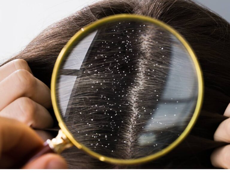 Łupież pod lupą. Obrazek w artykule Domowy sposób na łupież. Skuteczne metody na pozbycie się łupieżu