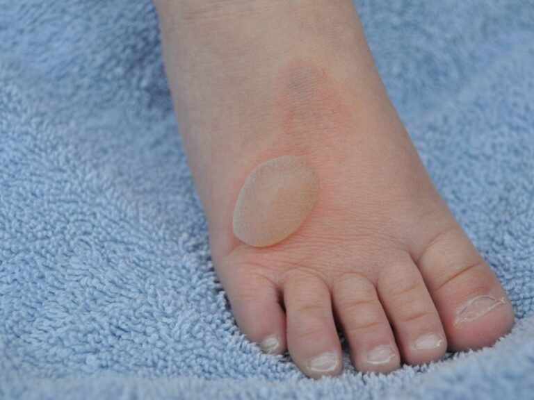 Stopa z bąblem. Obrazek w artykule Domowy sposób na oparzenia. Jak złagodzić ból i przyspieszyć gojenie oparzeń?
