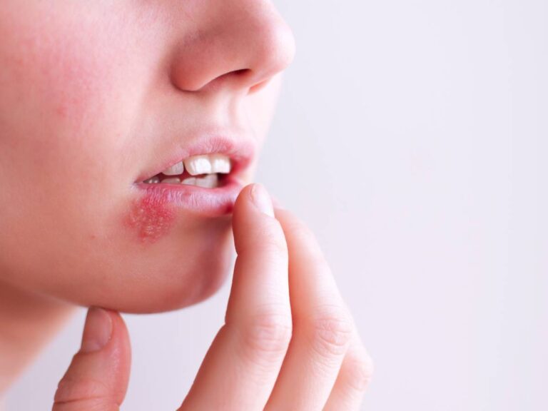 Twarz z opryszczką. Obrazek w artykule Domowy sposób na opryszczkę. Skuteczne sposoby na pozbycie się opryszczki.