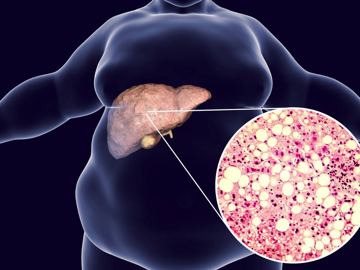 Grafika z chorą wątrobą. Obrazek w artykule Domowy sposób na stłuszczenie wątroby: naturalne metody oczyszczania organizmu.