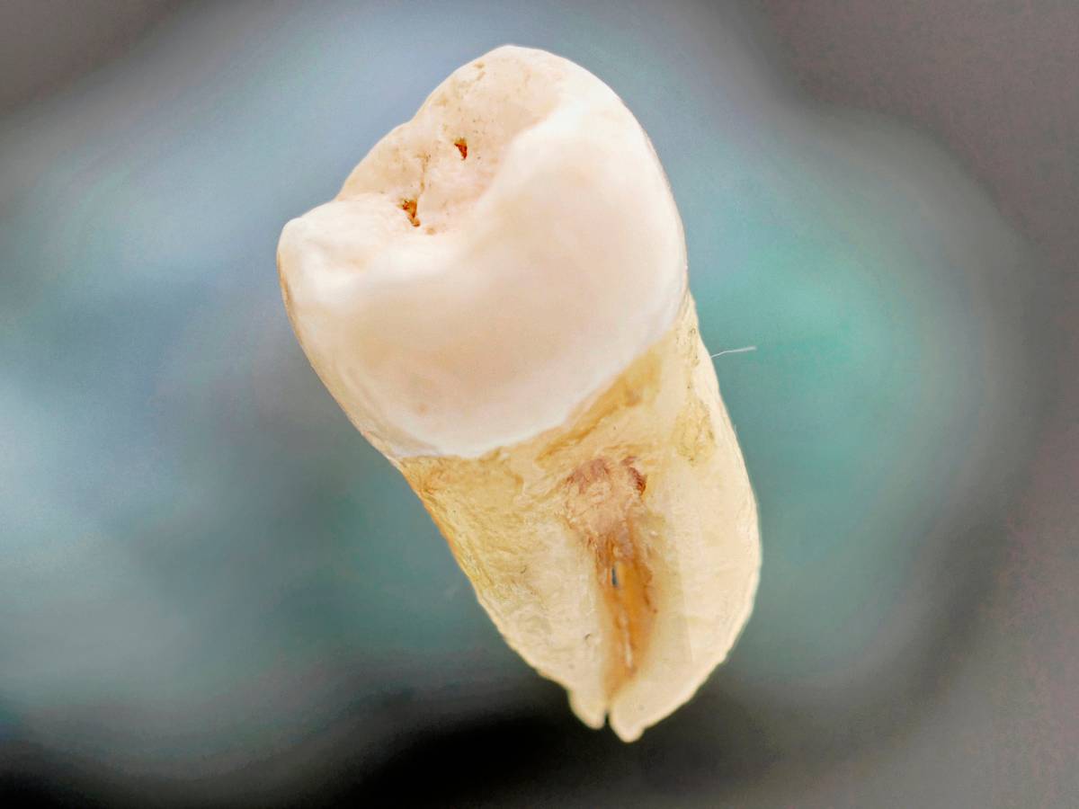 Wyrwany ząb. Obrazek w artykule Sposób na ból zęba z dziurą: Skuteczne sposoby na złagodzenie bólu