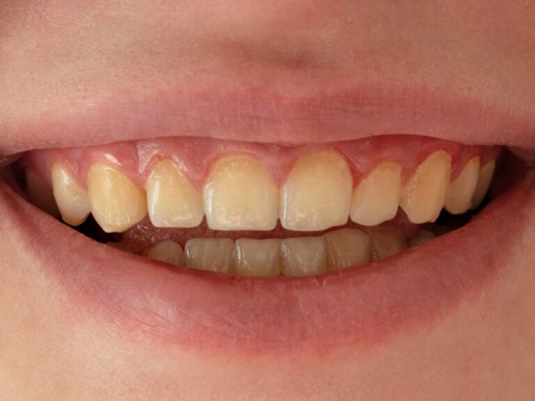 Uśmiech. Domowe sposoby na żółte zęby: Jak naturalnie wybielić zęby w domu