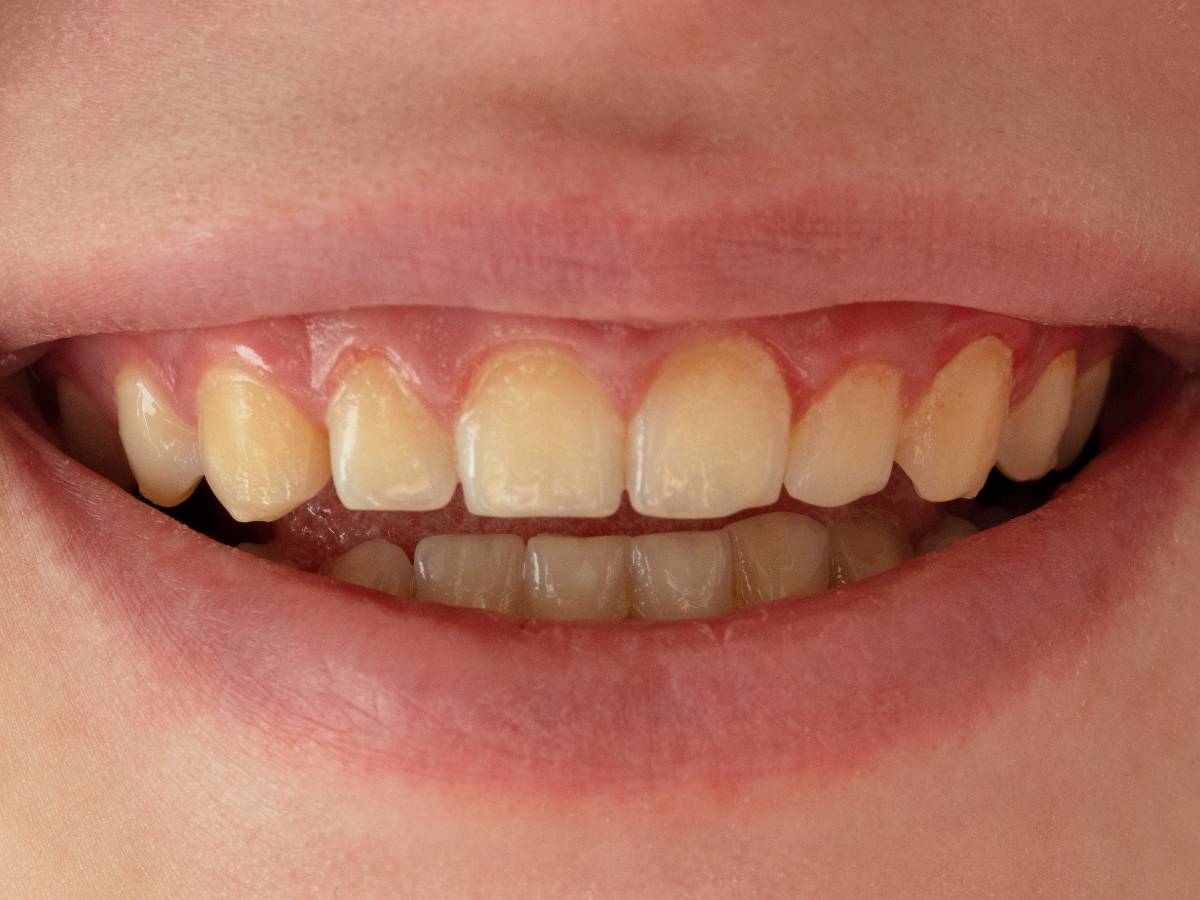 Uśmiech. Domowe sposoby na żółte zęby: Jak naturalnie wybielić zęby w domu